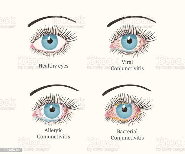 How to Treat Viral Conjunctivitis Effective Methods
